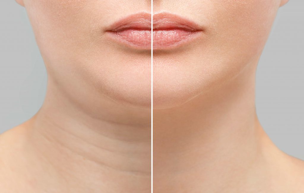 Double Chin Reduction Surgery in Indore, double chin reduction treatment in indore, double chin correction in indore